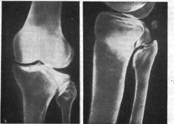 Перелом мыщелка берцовой кости реабилитация