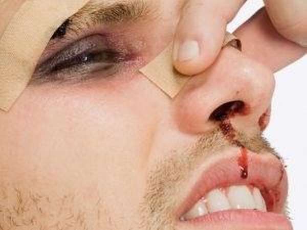Как получить перелом носа