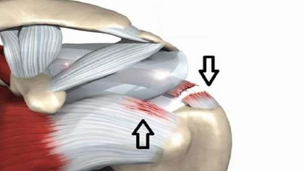 Повреждение поворотной манжеты плечевого сустава