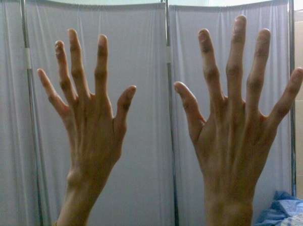 Паучья форма пальцев рук характерна для синдрома
