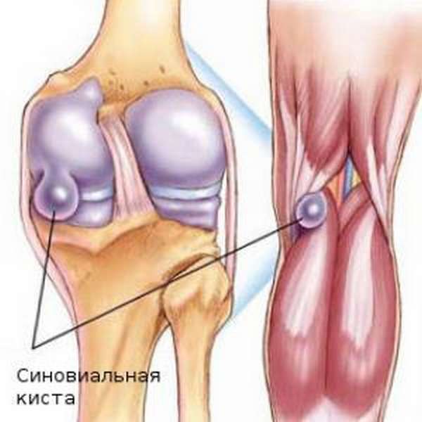 Многокамерная синовиальная киста коленного сустава