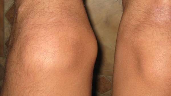 Бурсит коленного сустава - симптомы, причины и лечение | «СМ-Клиника»