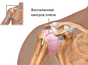 Адгезивный капсулит плечевого сустава народные средства