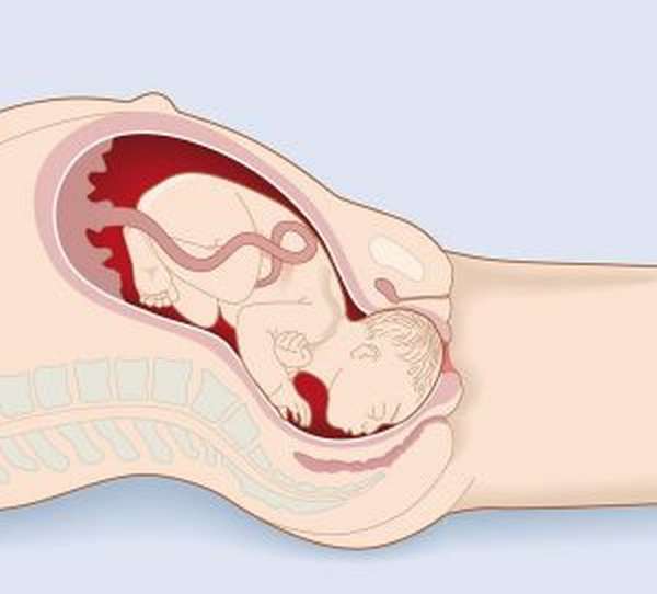 Варикозное расширение вен малого таза при беременности