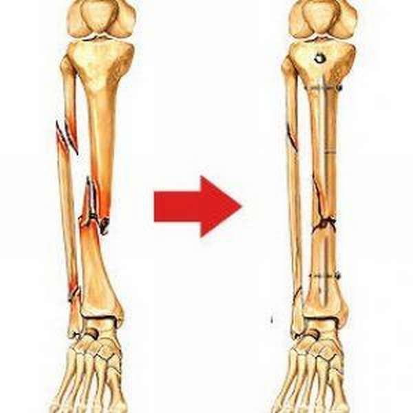 Как встать на ноги после перелома берцовой кости