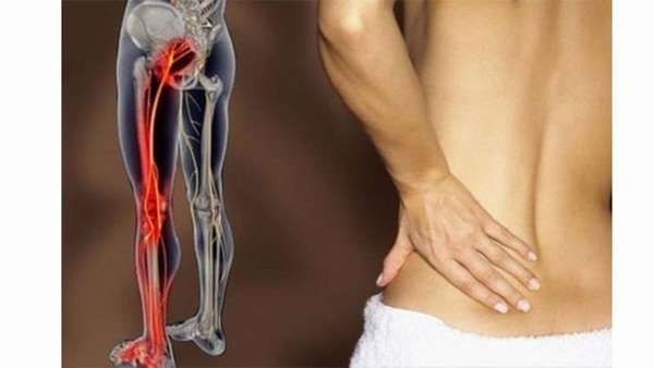 Как вылечить защемление нерв в тазобедренном суставе
