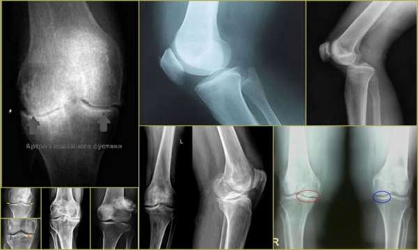 Ушиб колена на рентгене