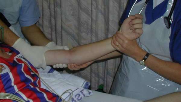 Рука после перелома головки лучевой кости
