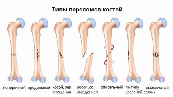 Как лечиться перелом ноги