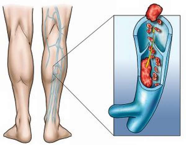 Осложнения при варикозе ног