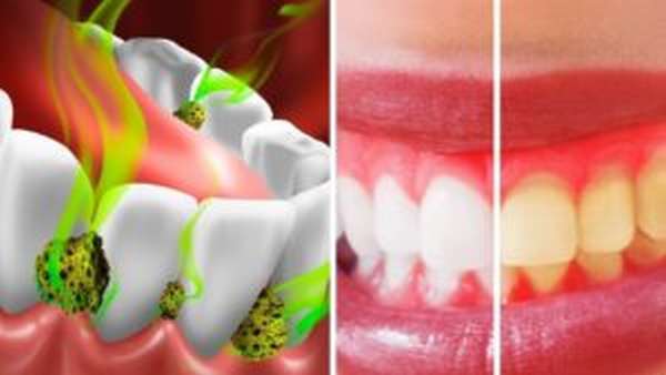 Вреден ли фтор в зубной пасте, его роль в организме