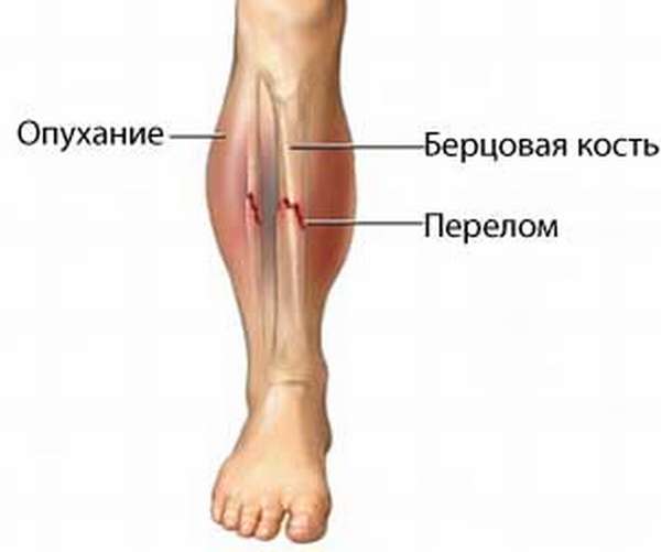 Нога после перелома большой берцовой и малой берцовой кости