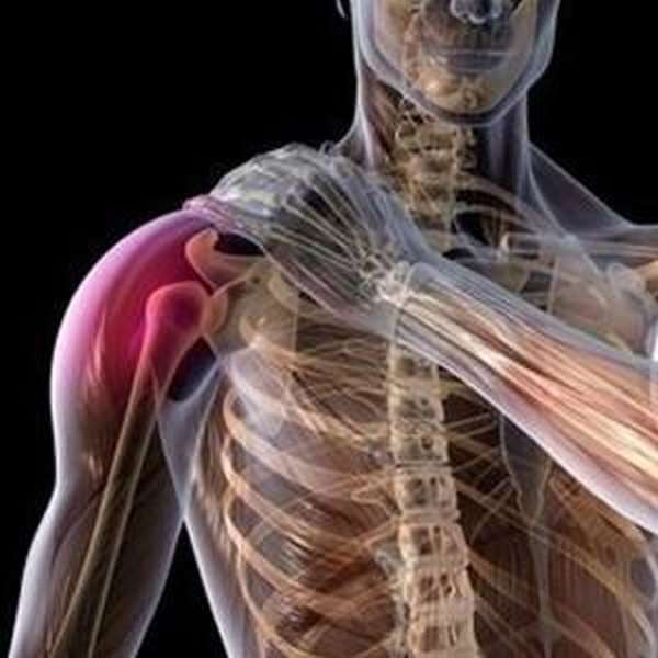 Перелом большого бугорка плечевой кости с вывихом