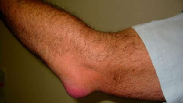 Опухоль локтевого сустава левой руки