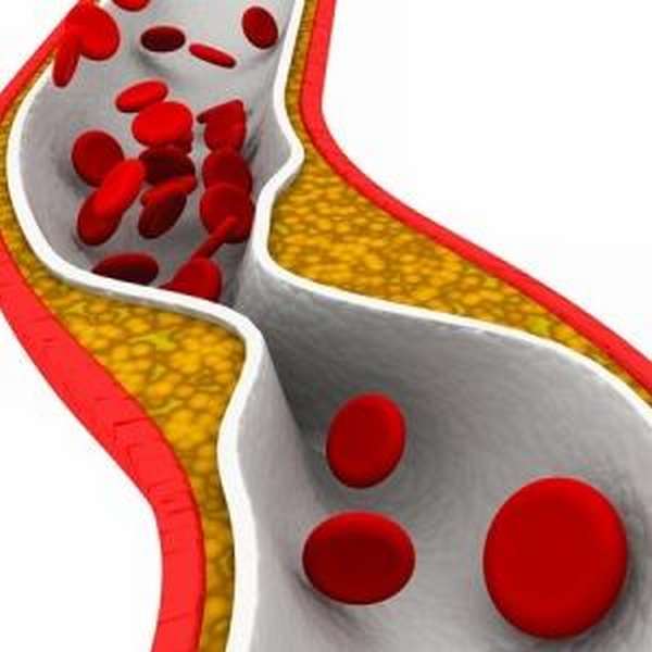 Что такое стеноз артерии позвоночника