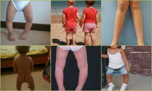 Ребенку 2 года ножки иксом как исправить