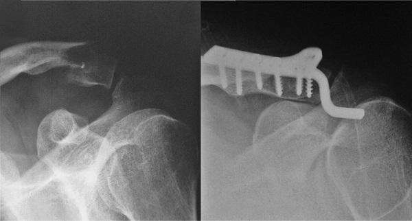 Разрыв акс плечевого сустава без операции thumbnail