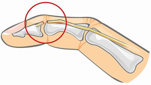 Разрыв сухожилий при переломе пальца руки