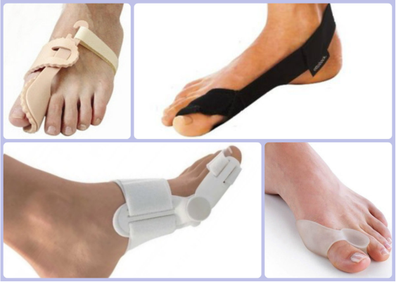 Ортопедическая операция ног. Халюс вальгус ортопедические приспособления. Фиксатор 1 пальца стопы при халюс вальгус. Ортопед халюс вальгус. Халюс вальгус 4 степени.