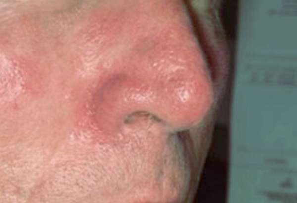 Причины и лечение купероза на носу