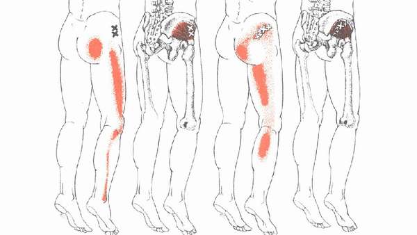 Почему болят мышцы ягодичные мышцы thumbnail