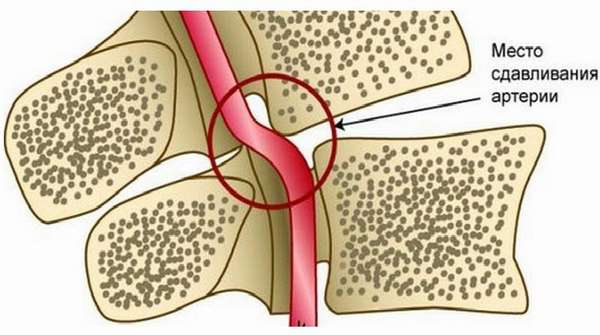 Синдром позвоночной артерии и экстравазальная компрессия thumbnail