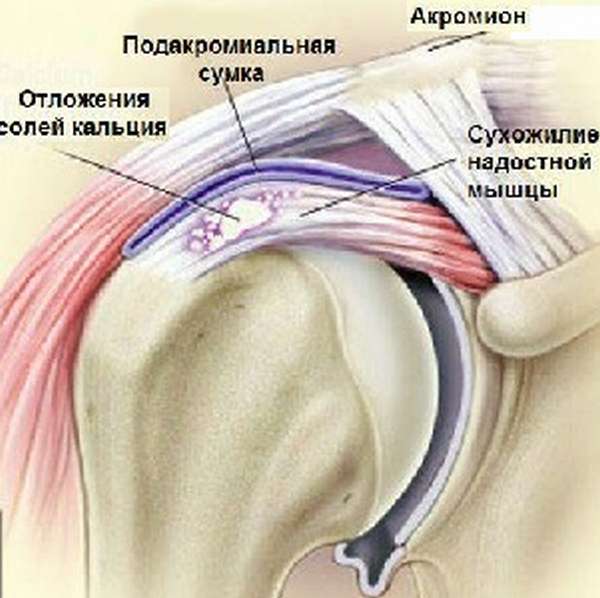 Ушиб сухожилия плечевой мышцы