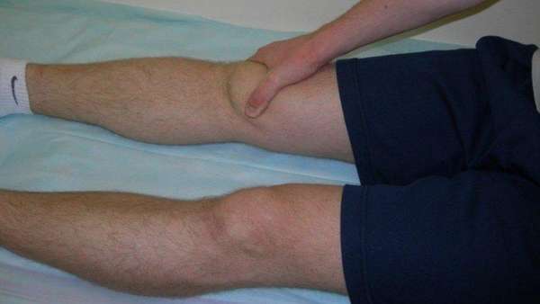 Остеонекроз коленного сустава лечение народными средствами