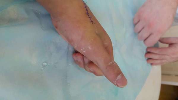 Разрыв сухожилий при переломе пальца руки