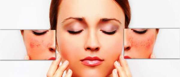 Симптомы и лечение купероза на лице