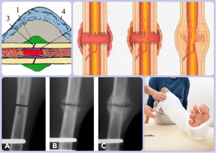 Как быстро образуется костная мозоль при переломе thumbnail