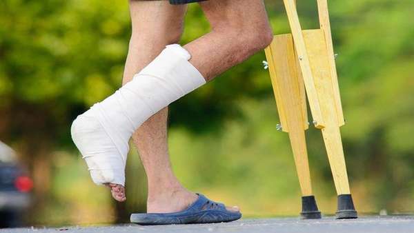 Как начать ходить после перелома боль