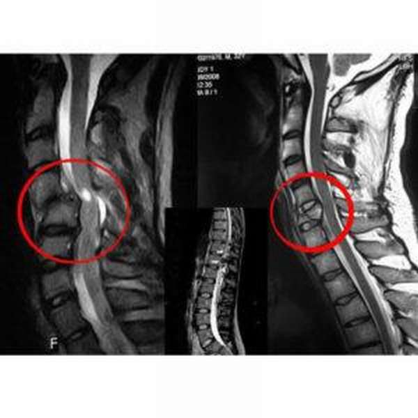 Признаки перелома позвоночника повреждения спинного мозга