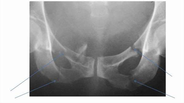 Лечение перелома лобковой кости