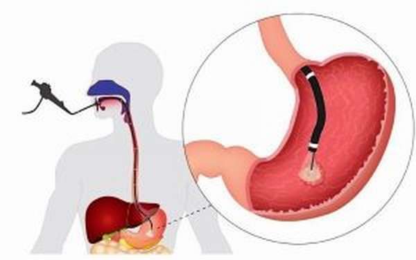 Кровотечение из варикозных вен пищевода