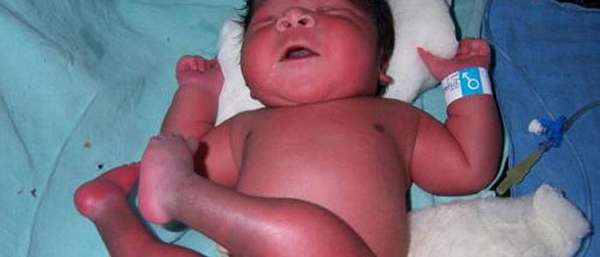 Тромбоз у новорожденных детей