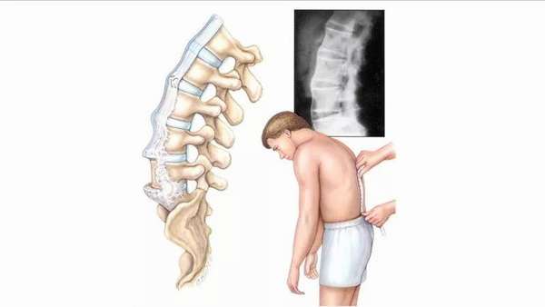 Синдром плоской спины у ребенка