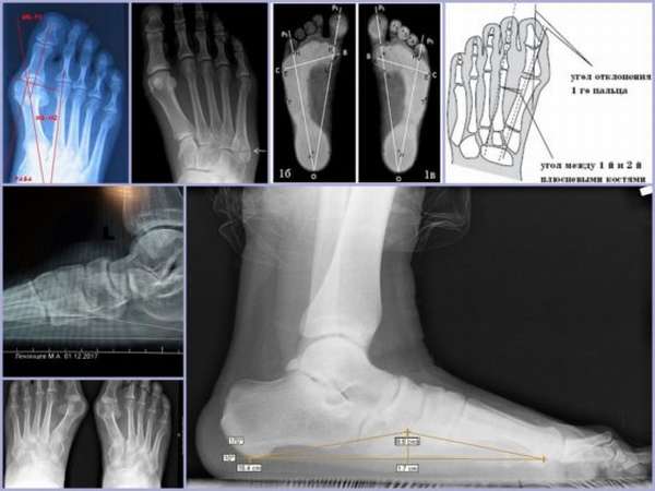 Плоскостопие рентген. Рентген стопы поперечное плоскостопие. Поперечное плоскостопие 3 степени рентген. Рентген стоп на продольное плоскостопие. Степени плоскостопия рентгенологически.