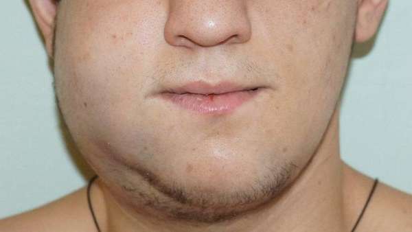 Переломов нижней челюсти фото до и после