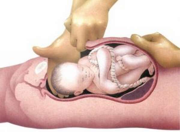 Тромбофилия во время беременности