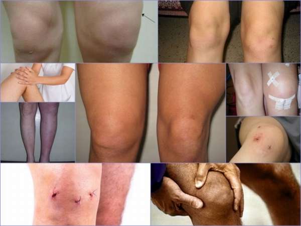 Артроскопия коленного сустава отек
