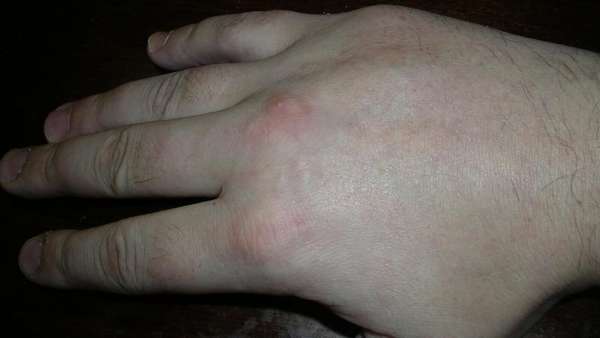 Переломы пальцев у боксеров