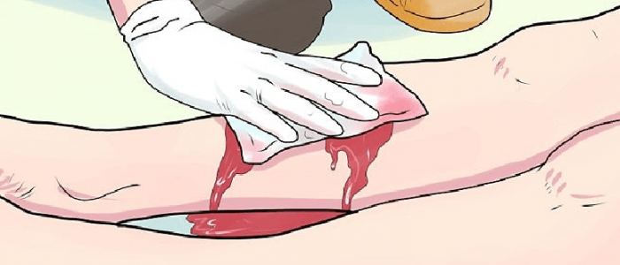 Кровотечение из варикозно-расширенных вен на ногах