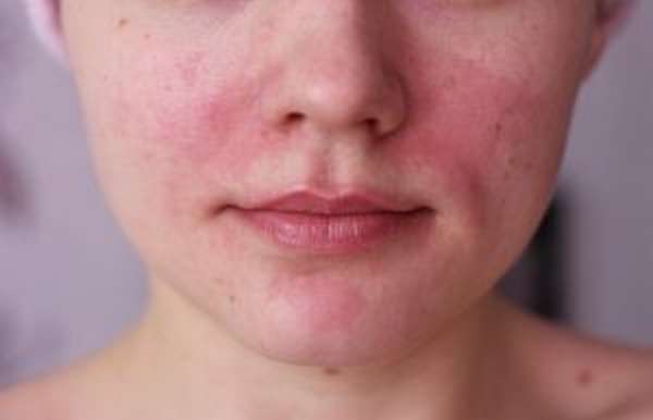 Почему появляются капилляры на лице?
