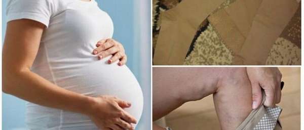 Антиварикозные чулки для беременных