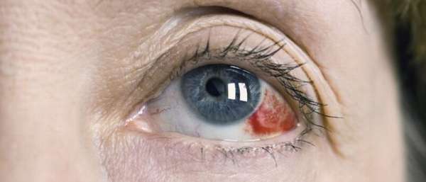 Почему лопается капилляр в глазу?
