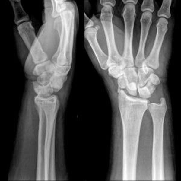 Операция при переломе запястья руки