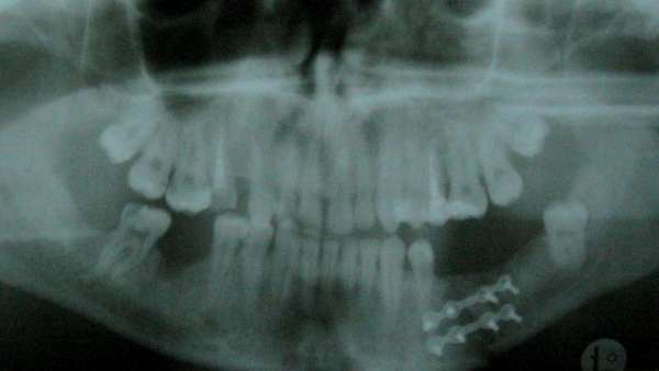 Операция при переломе челюсти фото