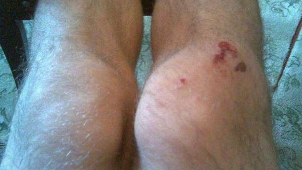 Синдром гусиной лапки коленного сустава что это такое thumbnail