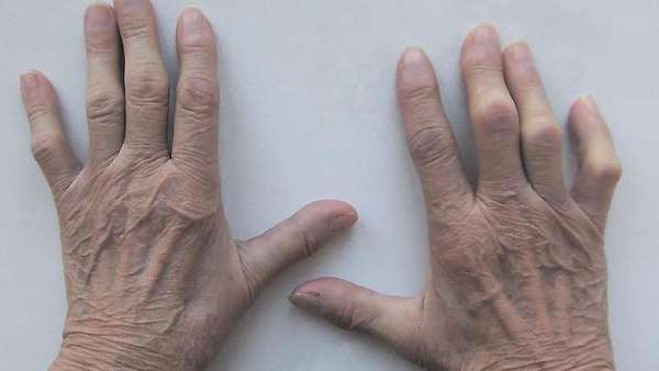 Остеопороз кистей рук лечение народными средствами